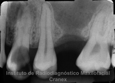 Fig. 1. Radiografía periapical de proceso alveolar 2.6.