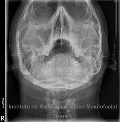 Fig. 3. Radiografía posteroanterior con proyección Waters.