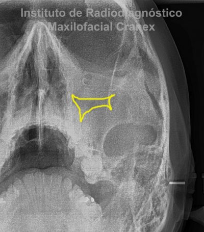 Fig. 4. Radiografía posteroanterior con proyección Waters (Close up).