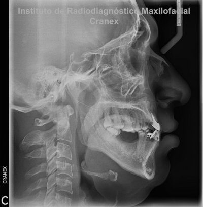 Fig. 3. Telerradiografía Lateral.