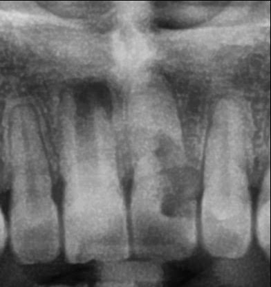Fig. 2. Radiografía Panorámica (Close up - piezas 1.1, 2.1)