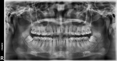 Fig. 1. Radiografía Panorámica.