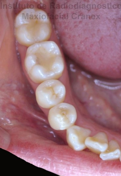 Fig. 1. Vista Oclusal. Notese la zona deprimida puntiforme en la region del surco central, entre las cuspides vestibular y lingual. 