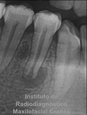 Fig. 2. Radiografía Panorámica (Close up - pieza 4.4)