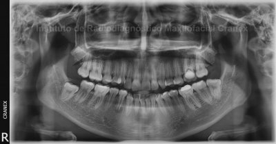 Fig. 2. Radiografía Panorámica.