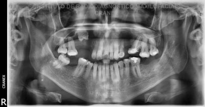 Fig. 1. Radiografía Panorámica.