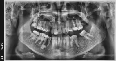 Fig. 1. Radiografía Panorámica
