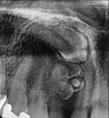 Fig. 2. Radiografía Panorámica (Close up - pieza 1.3)