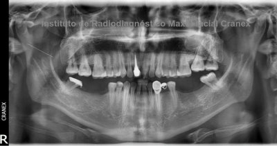 Fig. 1. Radiografía Panorámica.