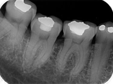 RX. Periapical