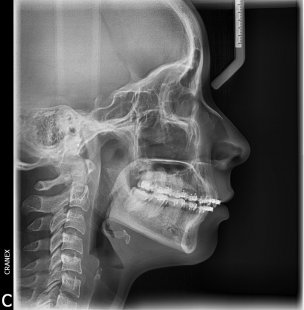 RX .Lateral Estricta