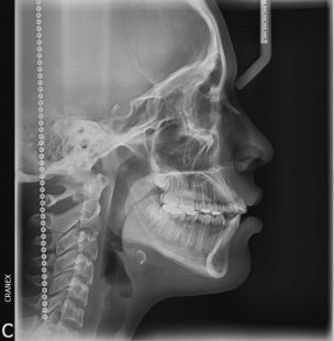 RX. Lateral en posición natural de la cabeza (PNC)