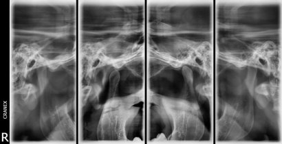 RX .A.T.M (Boca cerrada / Boca abierta )