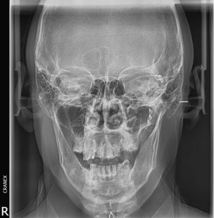 RX .Inversa de Towne