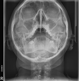 RX .Waters (Senos maxilares)