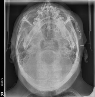 RX .Hirts (Arco cigomático)