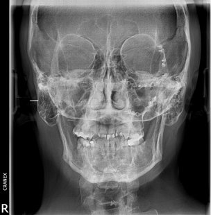 RX. Frontal (Postero-anterior)