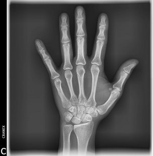 RX. Carpal (Edad  Ósea)